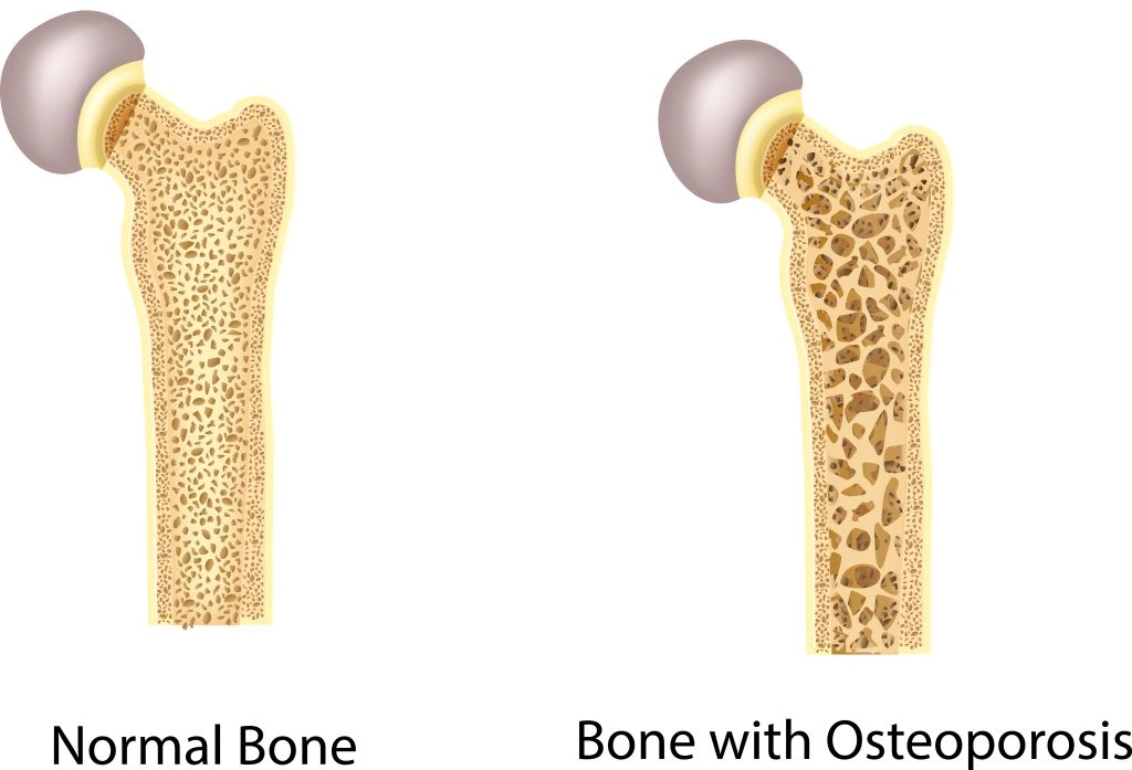 osteoporosis and treatment, osteoporosis symptoms, treating osteoporosis, osteoporosis medication, drugs for osteoporosis, osteoporosis medication, treatment of osteoporosis, osteoporosis diagnosis, symptoms of osteoporosis, ayurveda treatment for osteoporosis