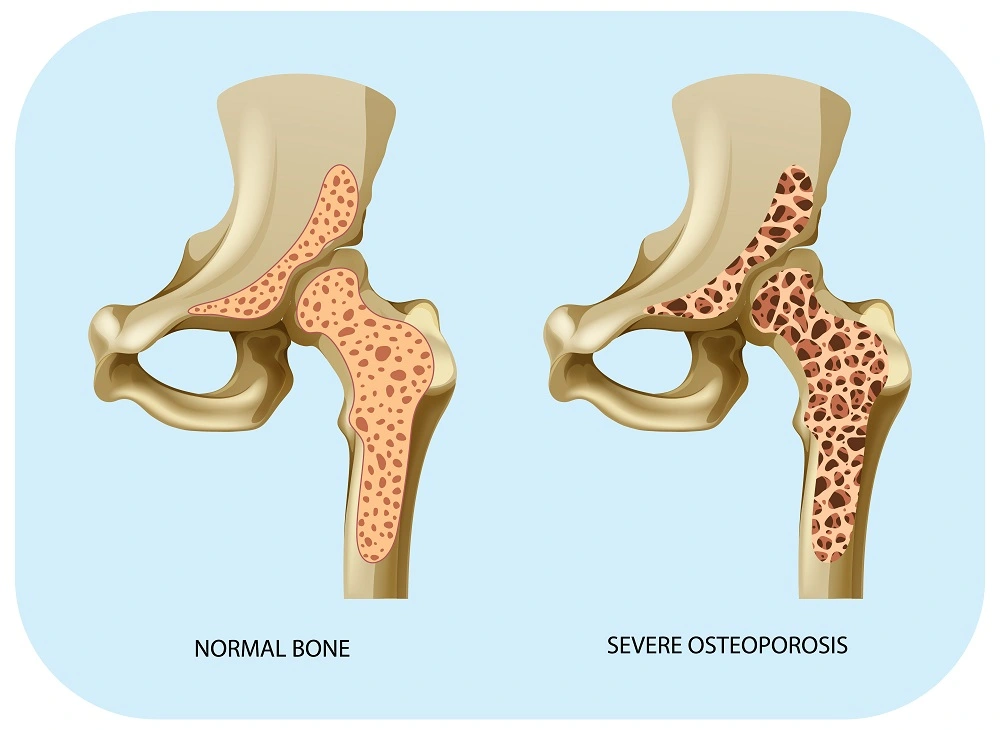 osteoporosis Medicine, osteoporosis medications, drugs for osteoporosis, osteoporosis self care, osteoporosis ayurvedic treatment, side effects of osteoporosis medicine, the cause of osteoporosis, symptoms for osteoporosis, natural treatment for osteoporosis, signs and symptoms of osteoporosis